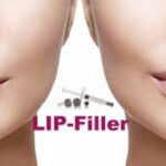 lips-filler1